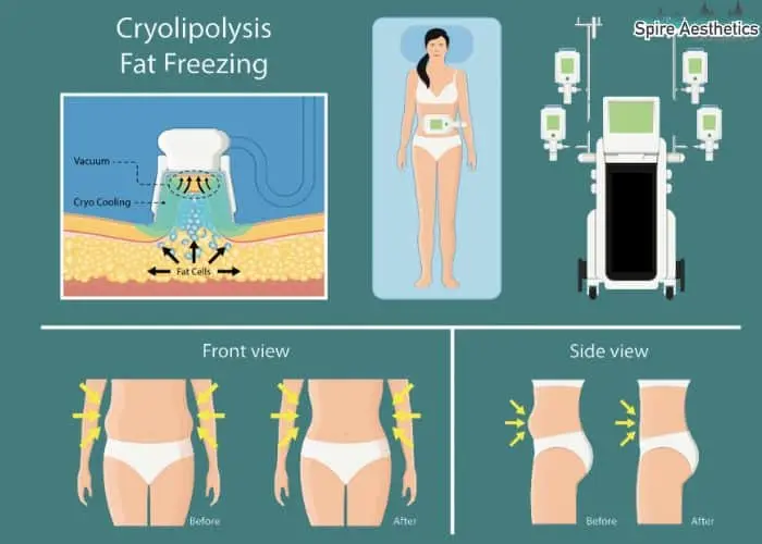 Fat freezing treatment Midhurst benefits for competitions to remove stubborn fat deposits.