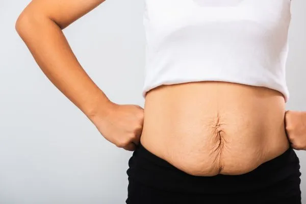 Image of a woman's stomach after weight loss with sagging skin following a gastric band Midhurst