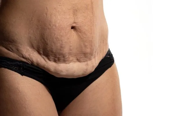 Image of womans stomach after weight loss injections Midhurst showing saggy skin
